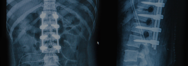 Spinal Cord Injury